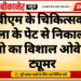 पीबीएम के चिकित्सकों ने महिला के पेट से निकाला 20 किलो का विशाल ओवेरियन ट्यूमर